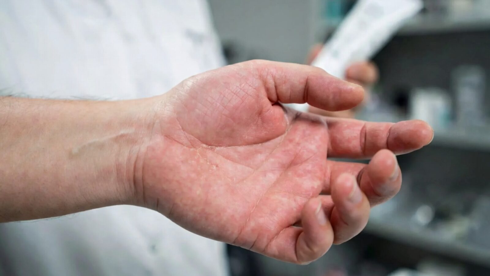Atopic Dermatitis Adalah Penyebab, Gejala dan Cara Pengobatan yang Efektif