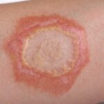 Ringworm Adalah Penyakit Kulit yang Perlu Segera Ditangani