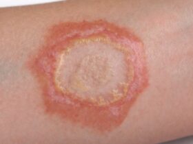 Ringworm Adalah Penyakit Kulit yang Perlu Segera Ditangani