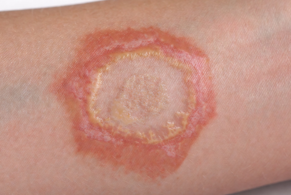 Ringworm Adalah Penyakit Kulit yang Perlu Segera Ditangani